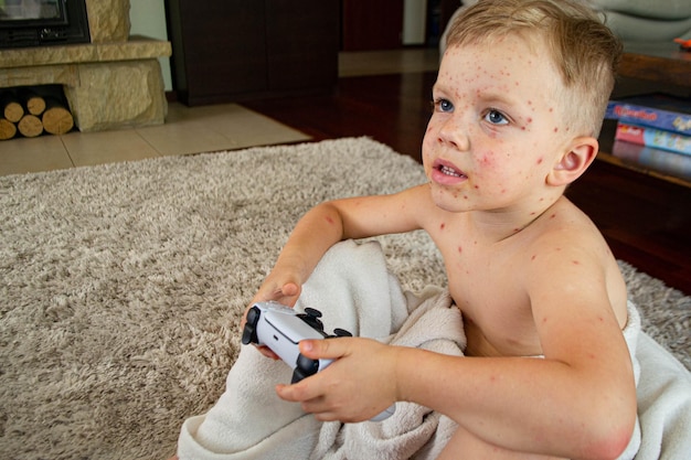 Ospa wietrzna: Jak wygląda i jakie ma objawy?