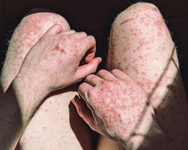 Różyczka: Objawy, Wysypka i Cechy Charakterystyczne