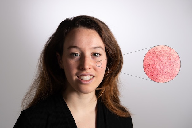 Trądzik różowaty: Objawy, Zdjęcia i Leczenie Choroby