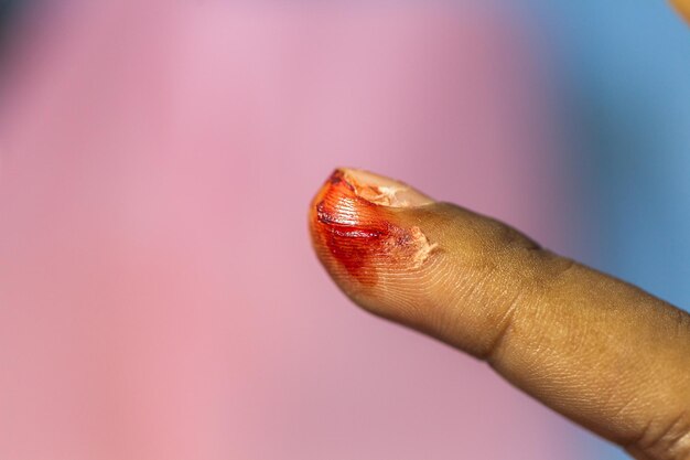 Zakażenie rany: Objawy, Przyczyny i Jak je Rozpoznać