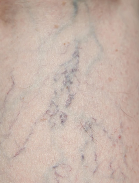 Naczyniaki: Jak Wyglądają i Jakie Mają Rodzaje?