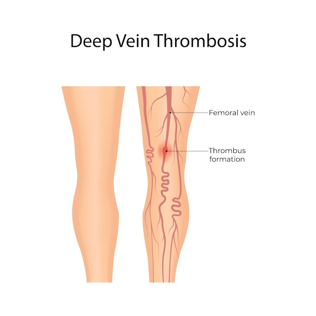 Żylaki nóg – Jak wyglądają? Zdjęcia i objawy!